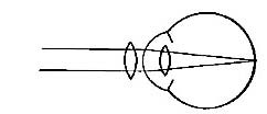 FIG. 80.&mdash;The defect is remedied by convex glasses.