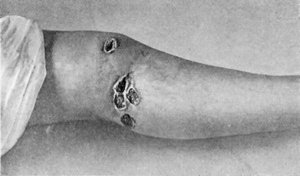 Fig. 17.&mdash;Syphilitic Ulcers in region of Knee, showing punched-out appearance and raised indurated edges.