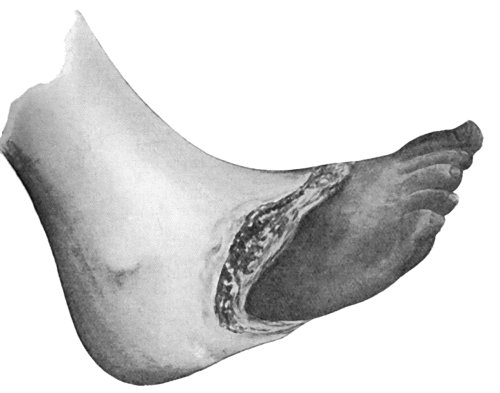 Fig. 20.&mdash;Senile Gangrene of the Foot, showing line of demarcation.