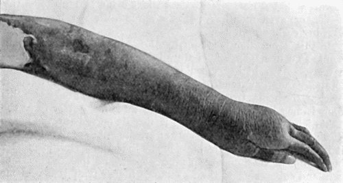 Fig. 21.&mdash;Embolic Gangrene of Hand and Arm.
