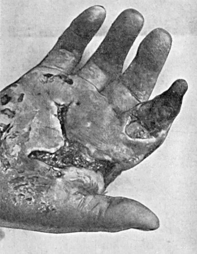 Fig. 22.&mdash;Gangrene of Terminal Phalanx of Index-Finger, following cellulitis of hand resulting from a scratch on the palm of the hand.