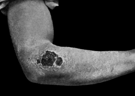 Fig. 29.&mdash;Malignant Pustule, fourteen days after infection, showing black eschar in process of separation. The œdema has largely disappeared. Treated by Sclavo's serum (cf. Fig. 28).