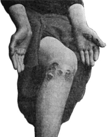Fig. 42.&mdash;Tertiary Syphilitic Ulceration in region of Knee and on both Thumbs of woman &aelig;t.&nbsp;37.