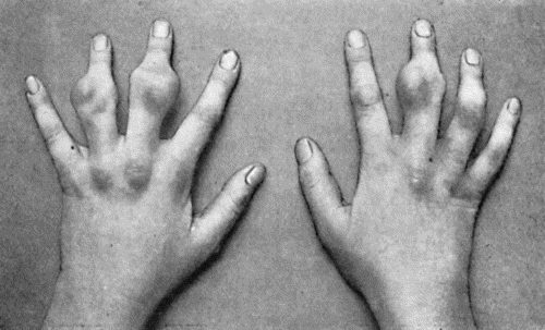 Fig. 48.&mdash;Zanthoma of Hands in a girl &aelig;t.&nbsp;14, showing multiple subcutaneous tumours (cf. Fig. 49). (Sir H.J. Stiles' case.)