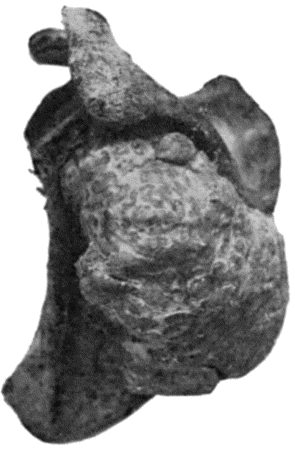 Fig. 50.&mdash;Chondroma growing from infraspinous fossa of Scapula.