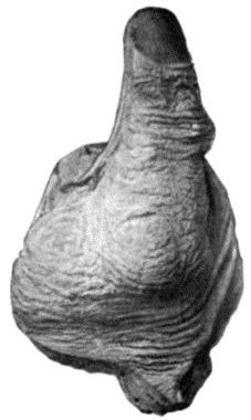 Fig. 51.&mdash;Chondroma of Metacarpal Bone of Thumb.