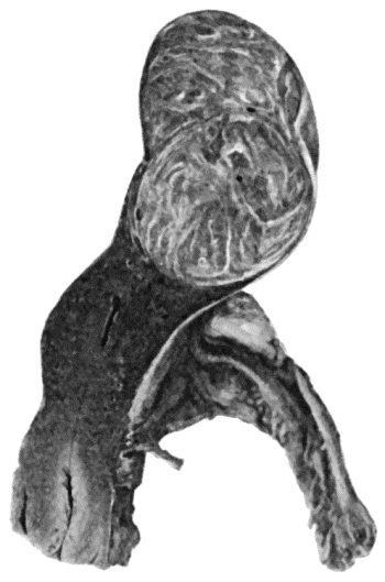 Fig. 54.&mdash;Fibro-myoma of Uterus.  (Anatomical Museum, University of Edinburgh.)