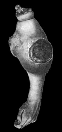 Fig. 56.&mdash;Fungating Sarcoma of Arm. (Dr. J. M'Watt's case.)