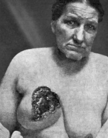 Fig. 57.&mdash;Carcinoma of Breast with Cancerous Ulcer.