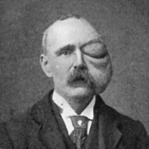 Fig. 70.&mdash;Cirsoid Aneurysm of Orbit and Face, which developed after a blow on the Orbit with a cricket ball. (From a photograph lent by Sir Montagu Cotterill.)