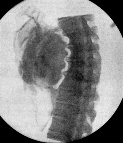 Fig. 71.&mdash;Radiogram of Aneurysm of Aorta, showing laminated clot and erosion of bodies of vertebr&aelig;. The intervertebral discs are intact.