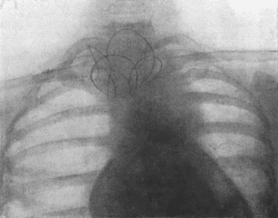 Fig. 73.&mdash;Radiogram of Innominate Aneurysm after treatment by the Moore-Corradi method. Two feet of finely drawn silver wire were introduced. The patient, a woman, &aelig;t.&nbsp;47, lived for ten months after operation, free from pain (cf. Fig. 75).