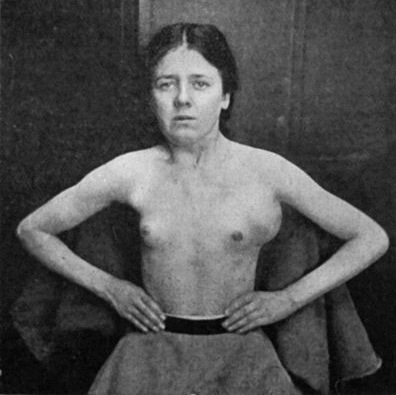 Fig. 79.&mdash;Tuberculous Axillary Glands (cf. Fig. 78).