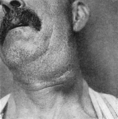 Fig. 83.&mdash;Cancerous Glands in Neck secondary to Epithelioma of Lip. (Mr. G.L. Chiene's case.)