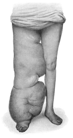 Fig. 89.&mdash;Elephantiasis Neuromatosa in a woman &aelig;t.&nbsp;28