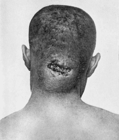 Fig. 95.&mdash;Carbuncle of seventeen days' duration in a woman &aelig;t.&nbsp;57.