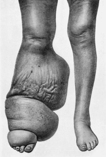 Fig. 97.&mdash;Elephantiasis in a woman &aelig;t.&nbsp;45.
