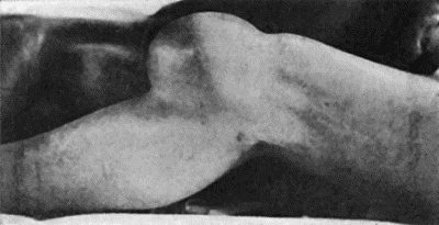 Fig. 113.&mdash;Hydrops of Prepatellar Bursa in a housemaid.