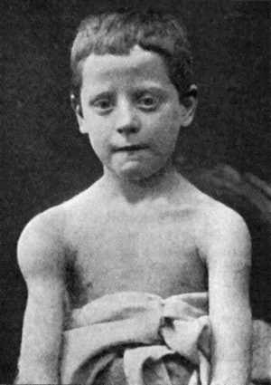Fig. 115.&mdash;Tuberculous Disease of Sub-deltoid Bursa. (From a photograph lent by Sir George T. Beatson.)
