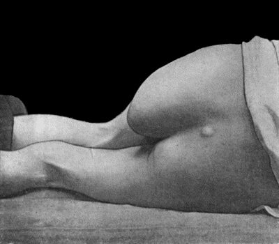 Fig. 116.&mdash;Great Enlargement of the Ischial Bursa. (Mr. Scot-Skirving's case.)