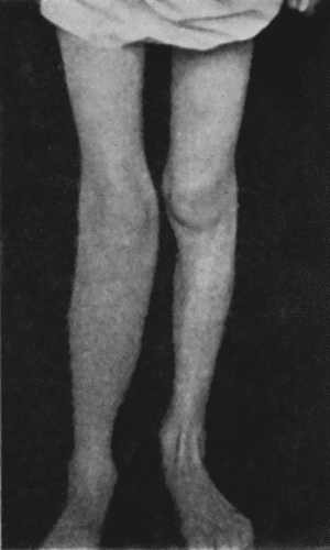 Fig. 126&mdash;Diffuse Tuberculous Osteomyelitis of Right Tibia. (Photograph lent by Sir H.J. Stiles.)