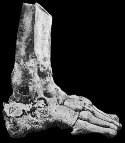 Fig. 127.&mdash;Advanced Tuberculous Disease in region of Ankle. The ankle-joint is ankylosed, and there is a large sequestrum in the calcaneus.  (Specimen in Anatomical Museum, University of Edinburgh.)
