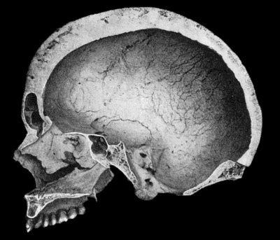 Fig. 134.&mdash;Changes in the Skull resulting from Ostitis Deformans. (Anatomical Museum, University of Edinburgh.)