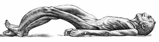 Fig. 135.&mdash;Cadaver, illustrating the alterations in the Lower Limbs resulting from Ostitis Deformans.