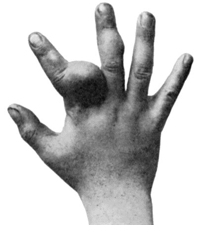 Fig. 144.&mdash;Multiple Chondromas in Hand of boy &aelig;t.&nbsp;8