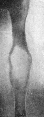 Fig. 145.&mdash;Radiogram of Myeloma of Humerus. (Mr. J.W. Struthers' case.)