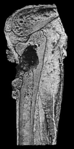 Fig. 153.&mdash;Epitheliomatous Ulcer of Leg with direct extension to Tibia. (Lord Lister's specimen. Anatomical Museum, University of Edinburgh.)