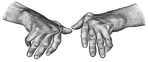 Fig. 160.&mdash;Arthritis Deformans of Hands, showing symmetry of lesions, ulnar deviation of fingers, and nodular thickening at inter-phalangeal joints.