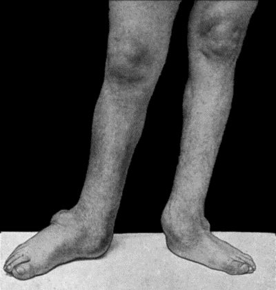 Fig. 164.&mdash;Charcot's Disease of both Ankles: front view. Man, &aelig;t.&nbsp;32.